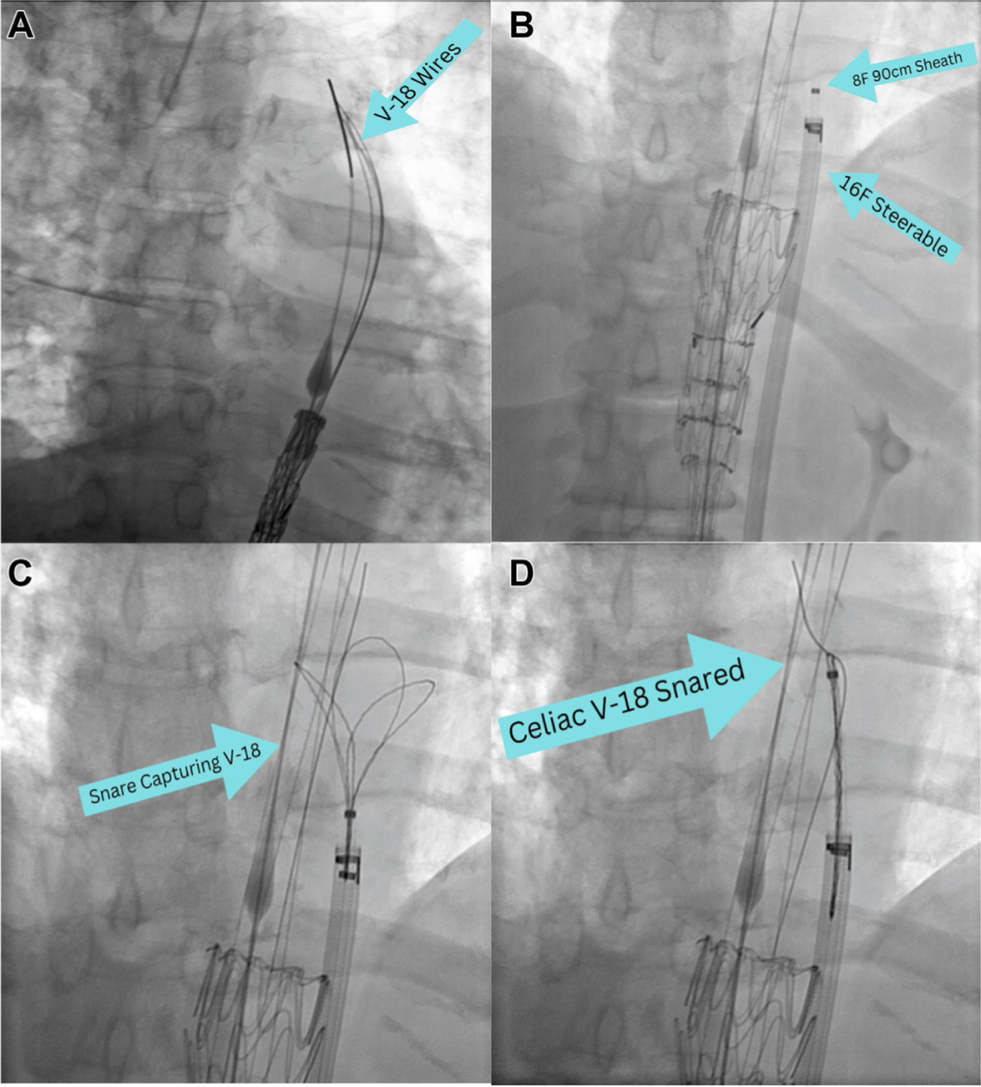 gore医疗怎么样TAMBE重塑复杂主动脉瘤治疗格局的技术解析_https://www.jmylbn.com_新闻资讯_第26张