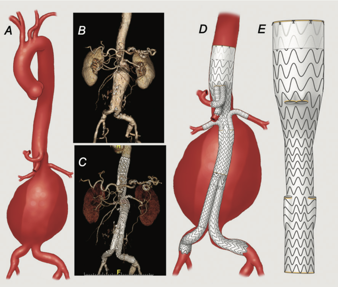 gore医疗怎么样TAMBE重塑复杂主动脉瘤治疗格局的技术解析_https://www.jmylbn.com_新闻资讯_第12张