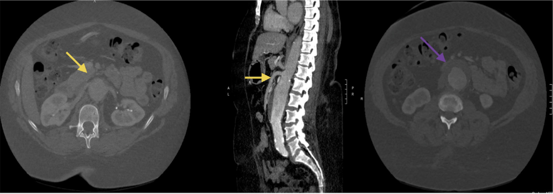 gore医疗怎么样TAMBE重塑复杂主动脉瘤治疗格局的技术解析_https://www.jmylbn.com_新闻资讯_第24张