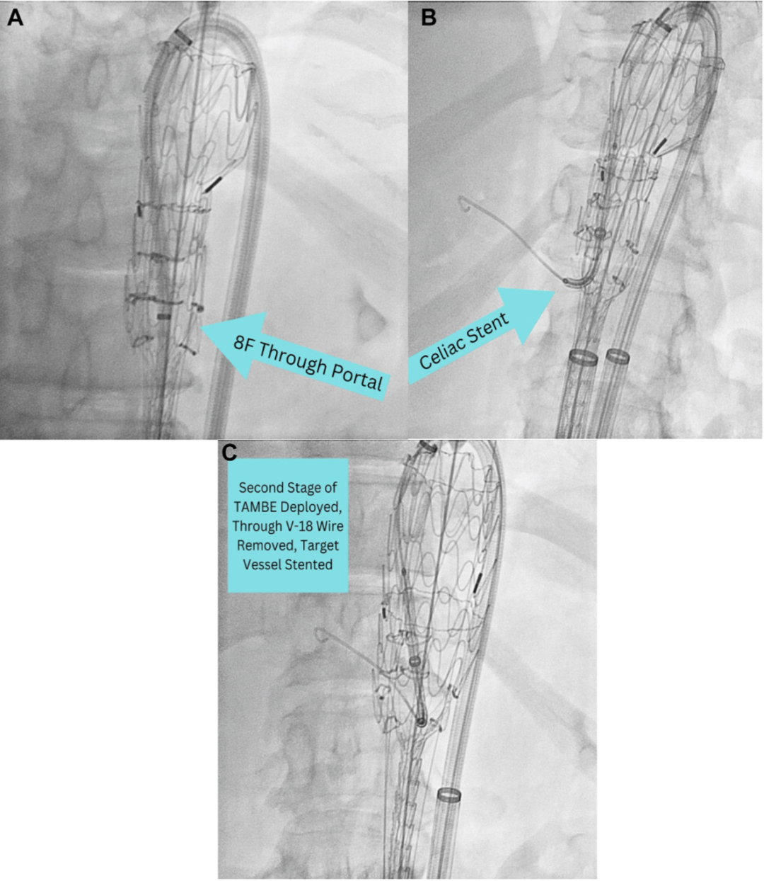 gore医疗怎么样TAMBE重塑复杂主动脉瘤治疗格局的技术解析_https://www.jmylbn.com_新闻资讯_第27张