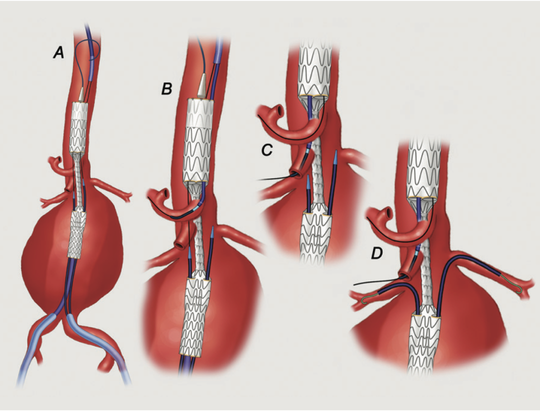 gore医疗怎么样TAMBE重塑复杂主动脉瘤治疗格局的技术解析_https://www.jmylbn.com_新闻资讯_第8张