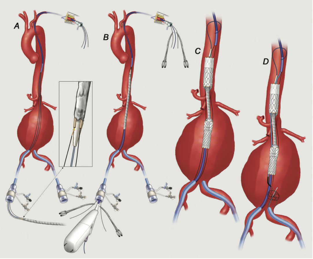 gore医疗怎么样TAMBE重塑复杂主动脉瘤治疗格局的技术解析_https://www.jmylbn.com_新闻资讯_第7张