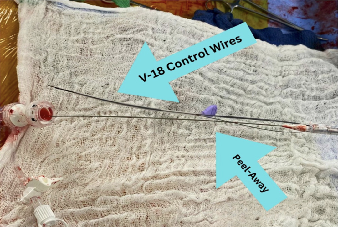 gore医疗怎么样TAMBE重塑复杂主动脉瘤治疗格局的技术解析_https://www.jmylbn.com_新闻资讯_第25张