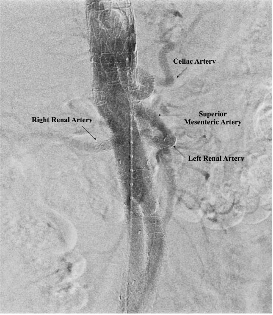 gore医疗怎么样TAMBE重塑复杂主动脉瘤治疗格局的技术解析_https://www.jmylbn.com_新闻资讯_第28张