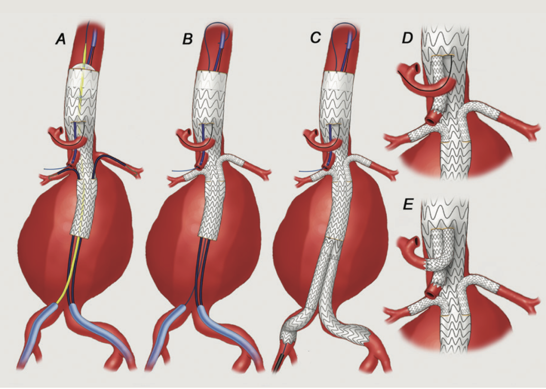 gore医疗怎么样TAMBE重塑复杂主动脉瘤治疗格局的技术解析_https://www.jmylbn.com_新闻资讯_第9张