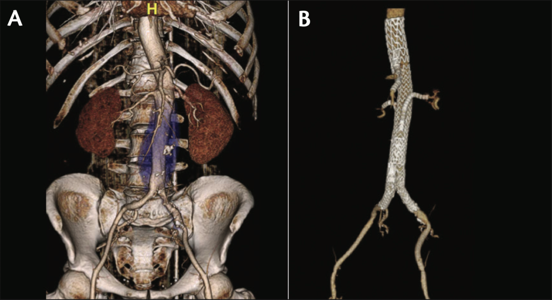 gore医疗怎么样TAMBE重塑复杂主动脉瘤治疗格局的技术解析_https://www.jmylbn.com_新闻资讯_第11张