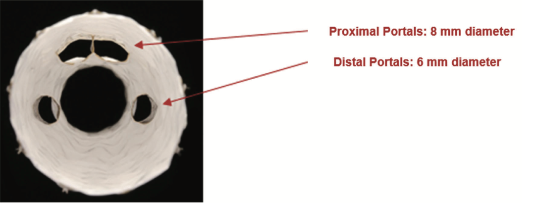 gore医疗怎么样TAMBE重塑复杂主动脉瘤治疗格局的技术解析_https://www.jmylbn.com_新闻资讯_第17张