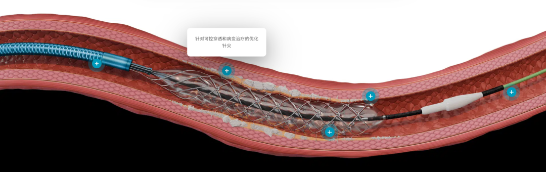 什么是外周支架雁过留声, 但它什么也没留下-外周可回收支架系统_https://www.jmylbn.com_新闻资讯_第11张
