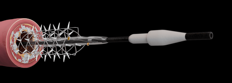 什么是外周支架雁过留声, 但它什么也没留下-外周可回收支架系统_https://www.jmylbn.com_新闻资讯_第12张