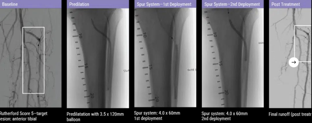 什么是外周支架雁过留声, 但它什么也没留下-外周可回收支架系统_https://www.jmylbn.com_新闻资讯_第19张