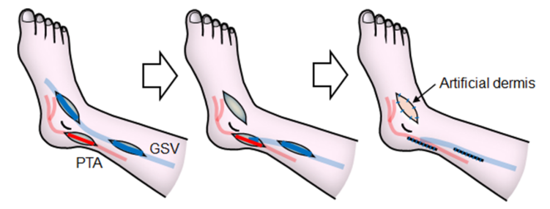 pta在医学上什么意思足背动脉旁路术：从技术革新到精准医疗_https://www.jmylbn.com_新闻资讯_第18张