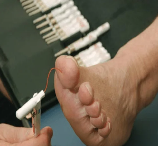 pta在医学上什么意思足背动脉旁路术：从技术革新到精准医疗_https://www.jmylbn.com_新闻资讯_第28张