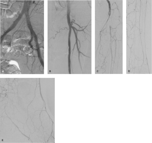 pta在医学上什么意思足背动脉旁路术：从技术革新到精准医疗_https://www.jmylbn.com_新闻资讯_第12张
