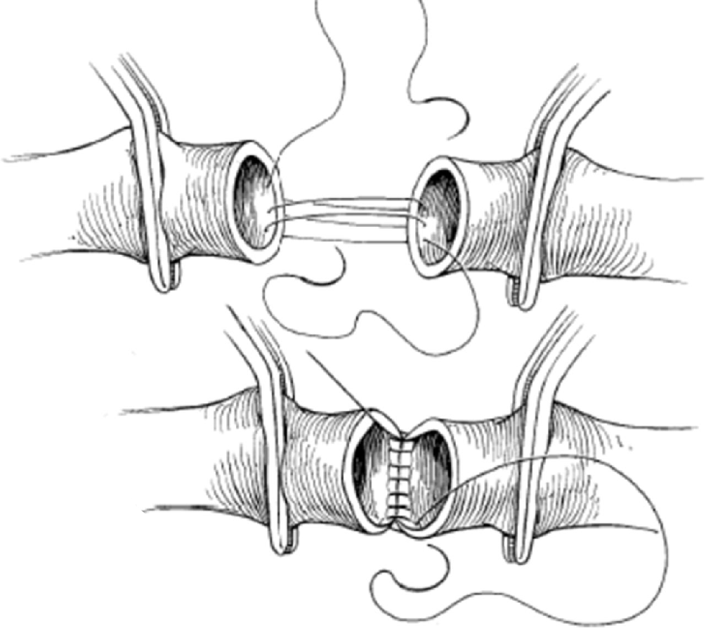 pta在医学上什么意思足背动脉旁路术：从技术革新到精准医疗_https://www.jmylbn.com_新闻资讯_第17张