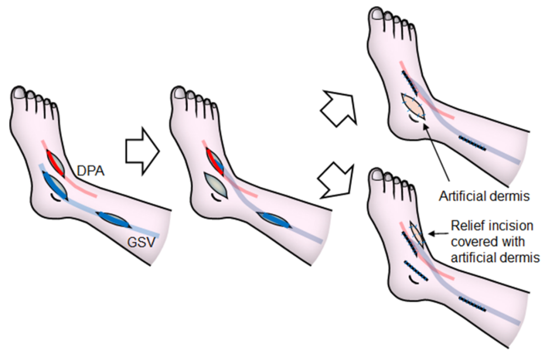 pta在医学上什么意思足背动脉旁路术：从技术革新到精准医疗_https://www.jmylbn.com_新闻资讯_第19张