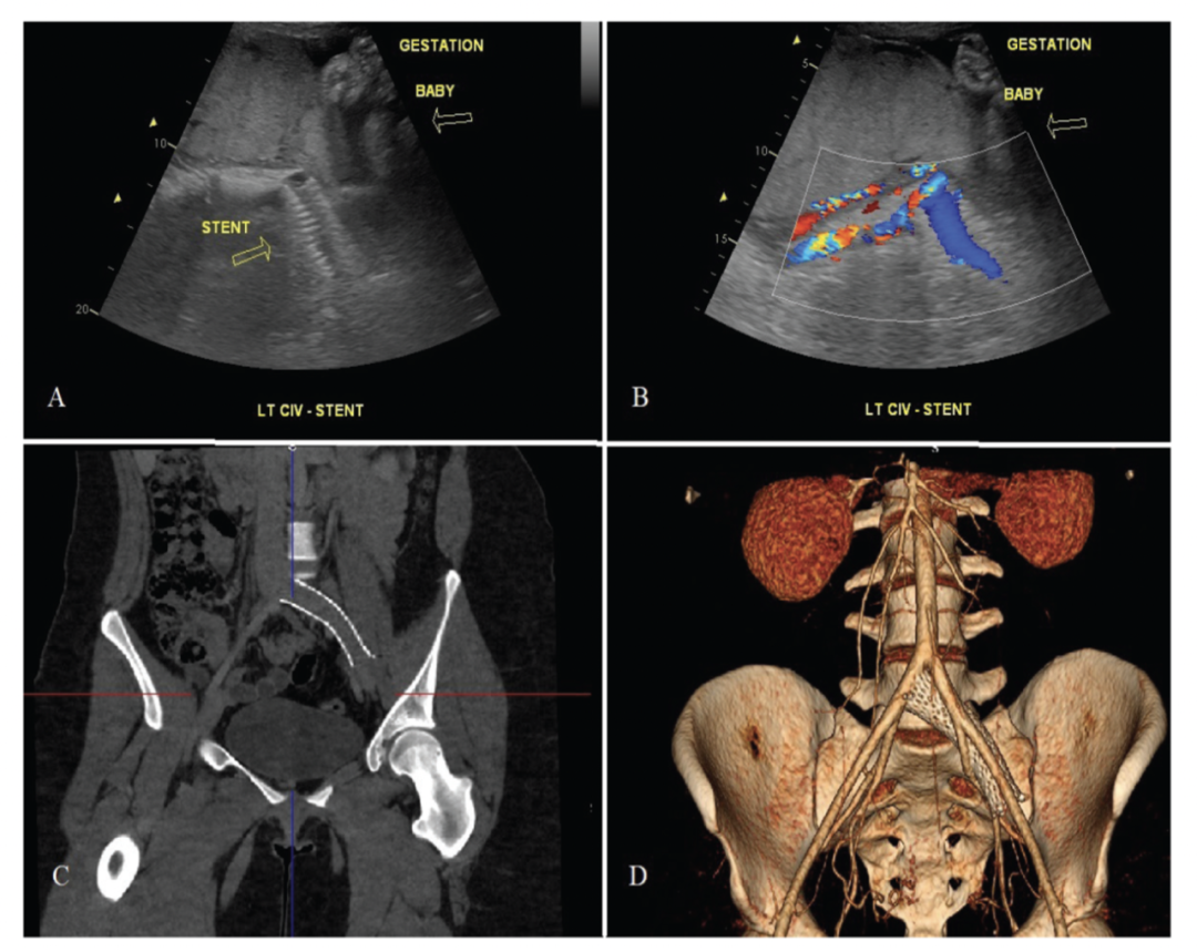 子宫支架是什么髂静脉支架能否耐受妊娠子宫？_https://www.jmylbn.com_新闻资讯_第14张