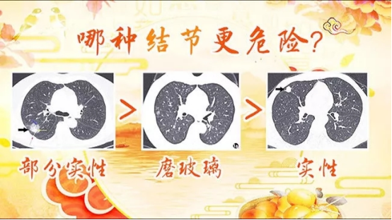 肺部结节 肺部结节