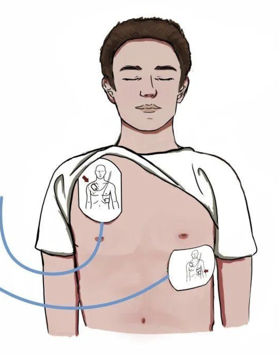 为什么电极能止血“世界急救日”，你会正确施救吗？_https://www.jmylbn.com_新闻资讯_第15张