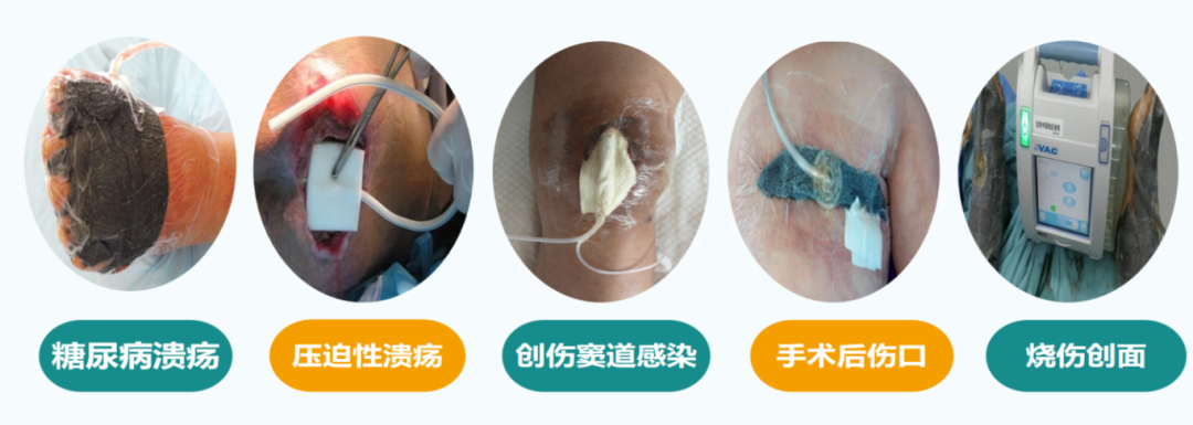 vsd引流器怎么连接【健康科普】创面的“吸尘器”——VSD负压封闭引流知多少？_https://www.jmylbn.com_新闻资讯_第3张