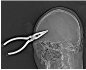 手术钳子怎么拿钳子意外插入脑袋，看看专家如何“拆弹”？_https://www.jmylbn.com_新闻资讯_第4张