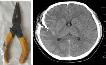 手术钳子怎么拿钳子意外插入脑袋，看看专家如何“拆弹”？_https://www.jmylbn.com_新闻资讯_第10张