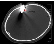 手术钳子怎么拿钳子意外插入脑袋，看看专家如何“拆弹”？_https://www.jmylbn.com_新闻资讯_第6张
