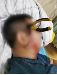 手术钳子怎么拿钳子意外插入脑袋，看看专家如何“拆弹”？_https://www.jmylbn.com_新闻资讯_第1张