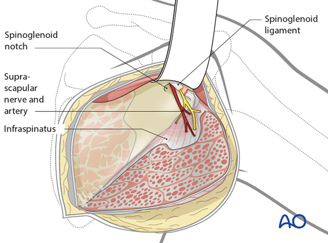 肩胛骨手术标准入路全解析：从解剖到操作的实战指南