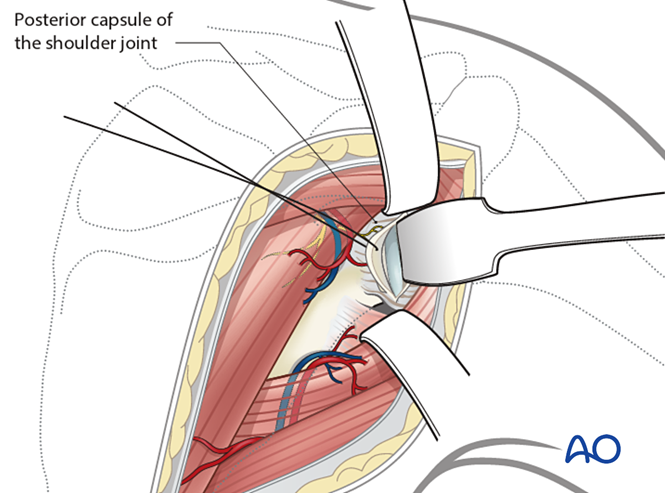 肩胛骨手术标准入路全解析：从解剖到操作的实战指南