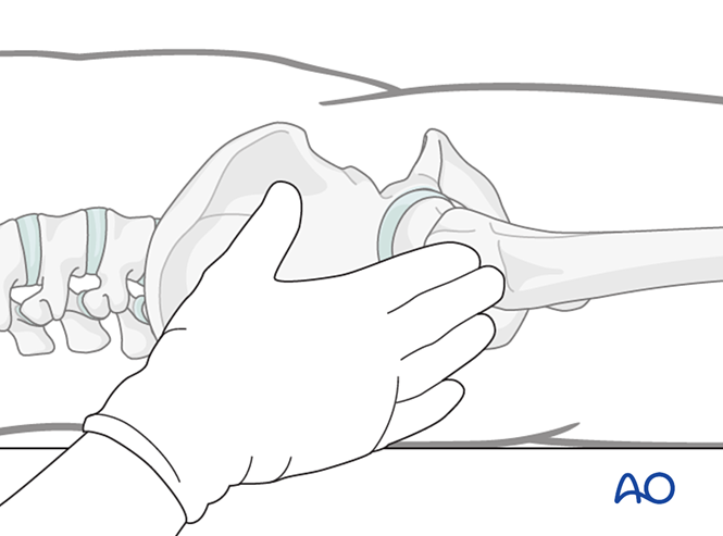 股骨转子间骨折髓内钉手术：进钉点与切口操作AO指南