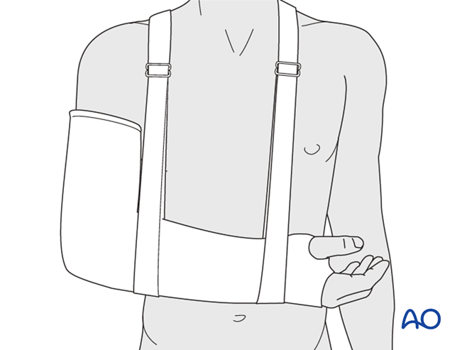 AO标准手术︱成人孟氏骨折脱位：复位顺序、固定技巧及术后护理要点详解