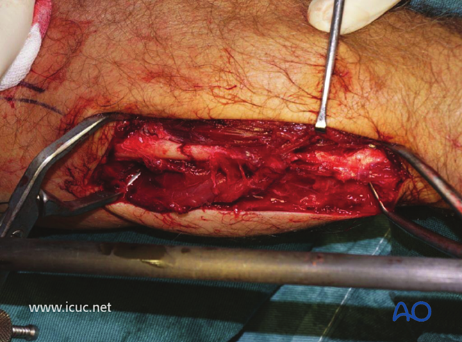 AO标准手术︱成人孟氏骨折脱位：复位顺序、固定技巧及术后护理要点详解