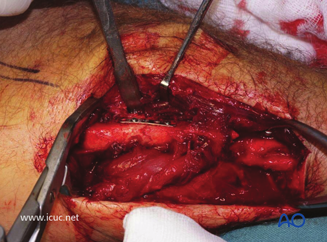 AO标准手术︱成人孟氏骨折脱位：复位顺序、固定技巧及术后护理要点详解