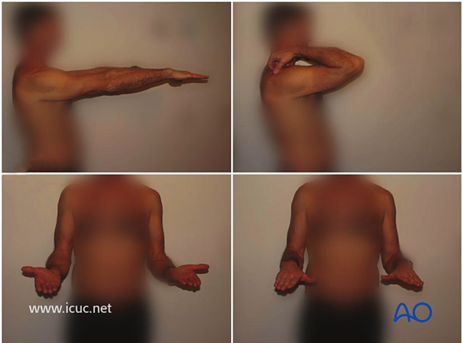AO标准手术︱成人孟氏骨折脱位：复位顺序、固定技巧及术后护理要点详解