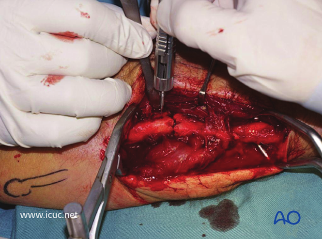 AO标准手术︱成人孟氏骨折脱位：复位顺序、固定技巧及术后护理要点详解