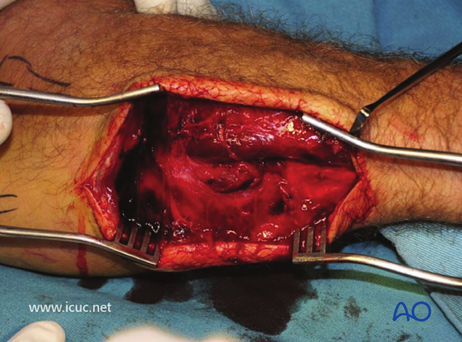 AO标准手术︱成人孟氏骨折脱位：复位顺序、固定技巧及术后护理要点详解