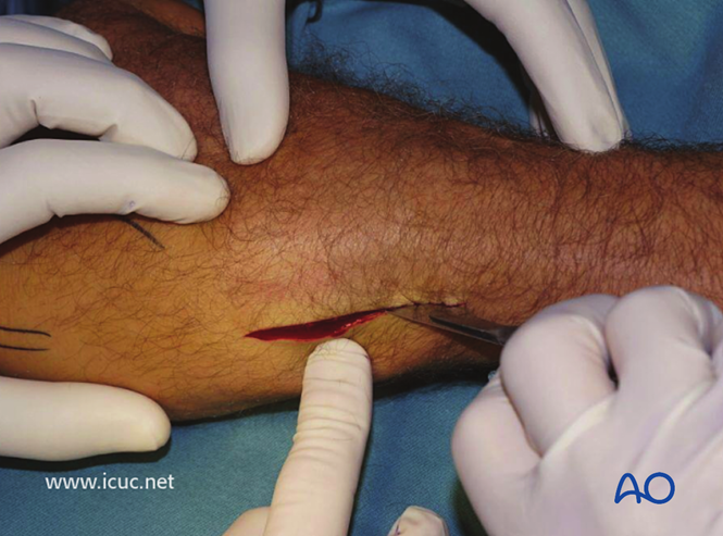 AO标准手术︱成人孟氏骨折脱位：复位顺序、固定技巧及术后护理要点详解