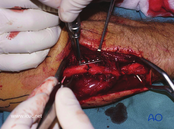 AO标准手术︱成人孟氏骨折脱位：复位顺序、固定技巧及术后护理要点详解