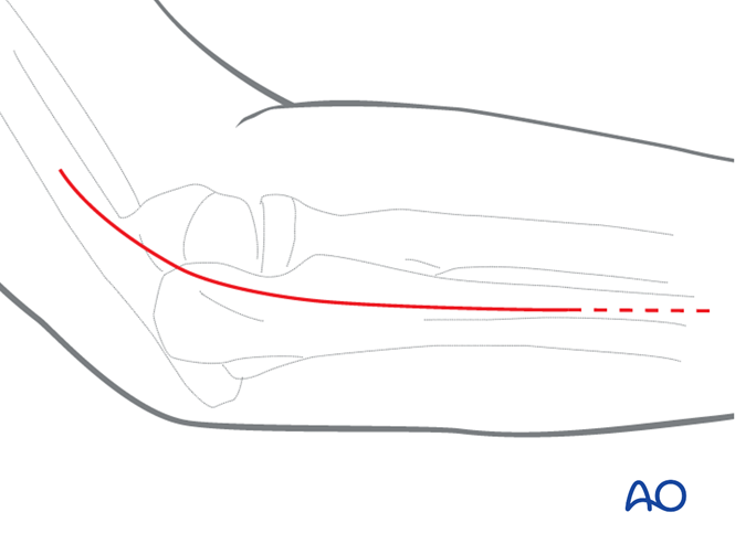 AO标准手术︱成人孟氏骨折脱位：复位顺序、固定技巧及术后护理要点详解