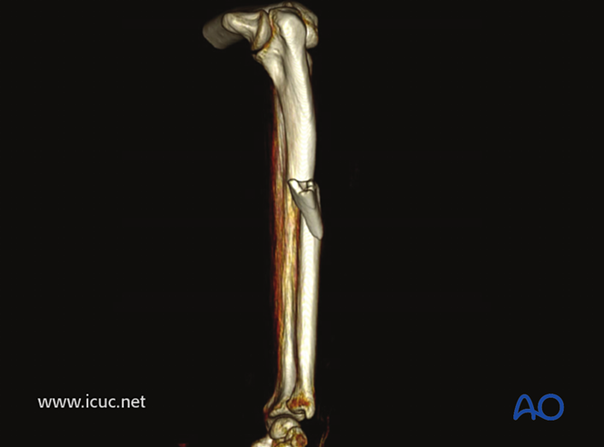 AO标准手术︱成人孟氏骨折脱位：复位顺序、固定技巧及术后护理要点详解