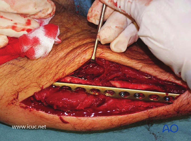 AO标准手术︱成人孟氏骨折脱位：复位顺序、固定技巧及术后护理要点详解
