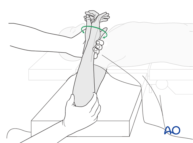 AO标准手术︱成人孟氏骨折脱位：复位顺序、固定技巧及术后护理要点详解