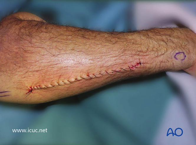 AO标准手术︱成人孟氏骨折脱位：复位顺序、固定技巧及术后护理要点详解