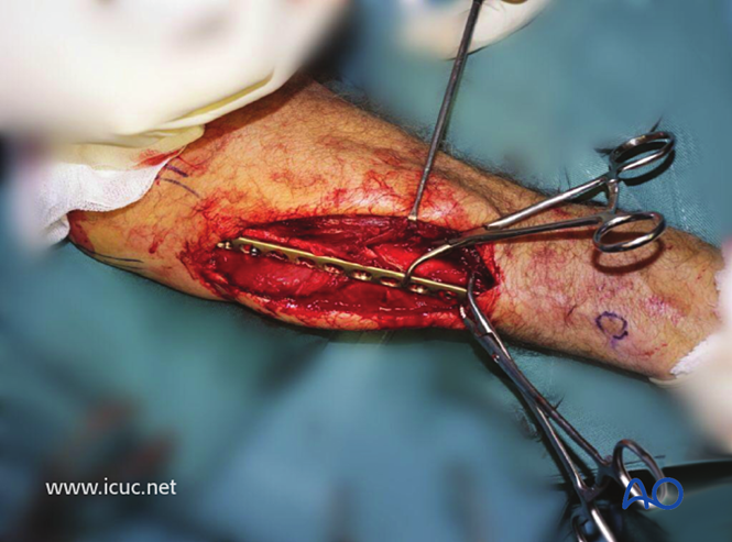 AO标准手术︱成人孟氏骨折脱位：复位顺序、固定技巧及术后护理要点详解