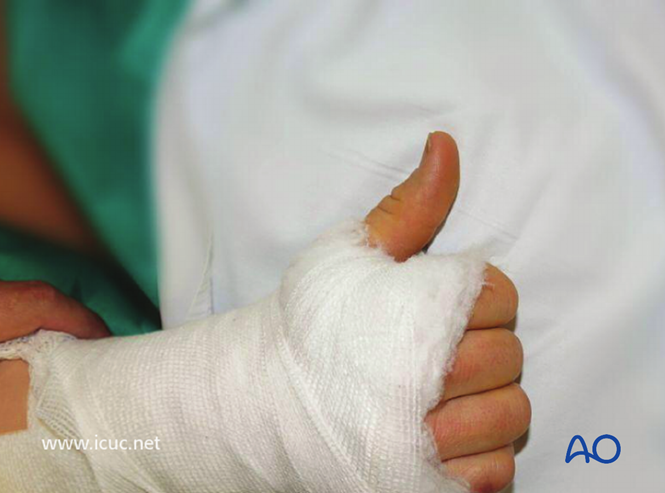AO标准手术︱成人孟氏骨折脱位：复位顺序、固定技巧及术后护理要点详解