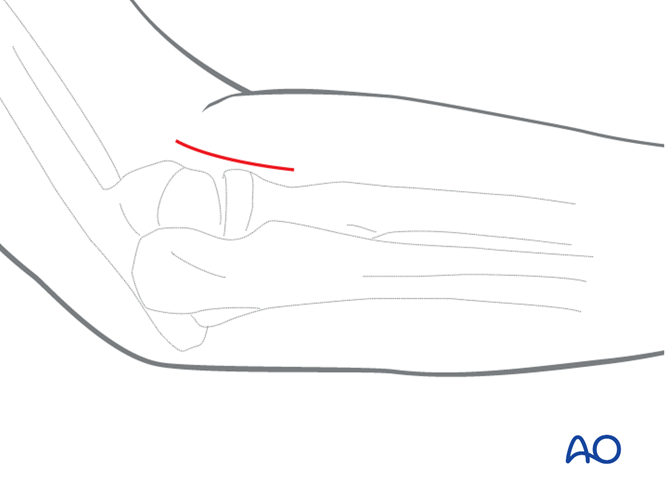 AO标准手术︱成人孟氏骨折脱位：复位顺序、固定技巧及术后护理要点详解