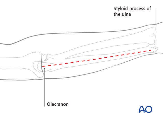 AO标准手术︱成人孟氏骨折脱位：复位顺序、固定技巧及术后护理要点详解