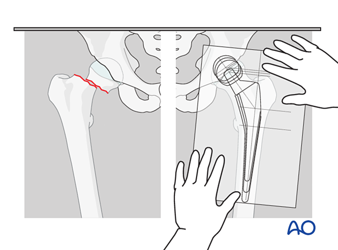 股骨颈骨折全髋关节置换术有哪些细节？看这篇AO指南就够了