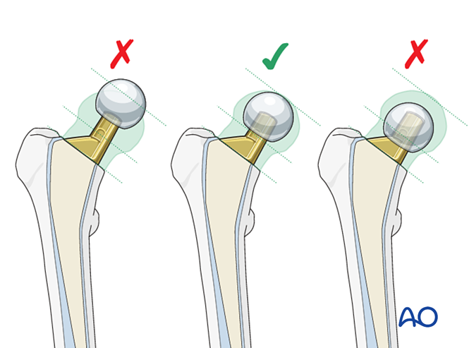 股骨颈骨折全髋关节置换术有哪些细节？看这篇AO指南就够了