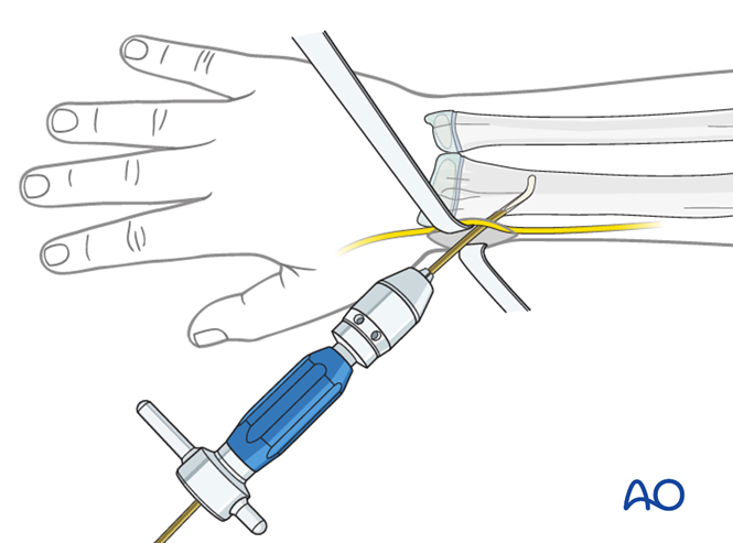 【手术技术】儿童尺桡骨双骨折的弹性髓内钉内固定（AO官网指南）